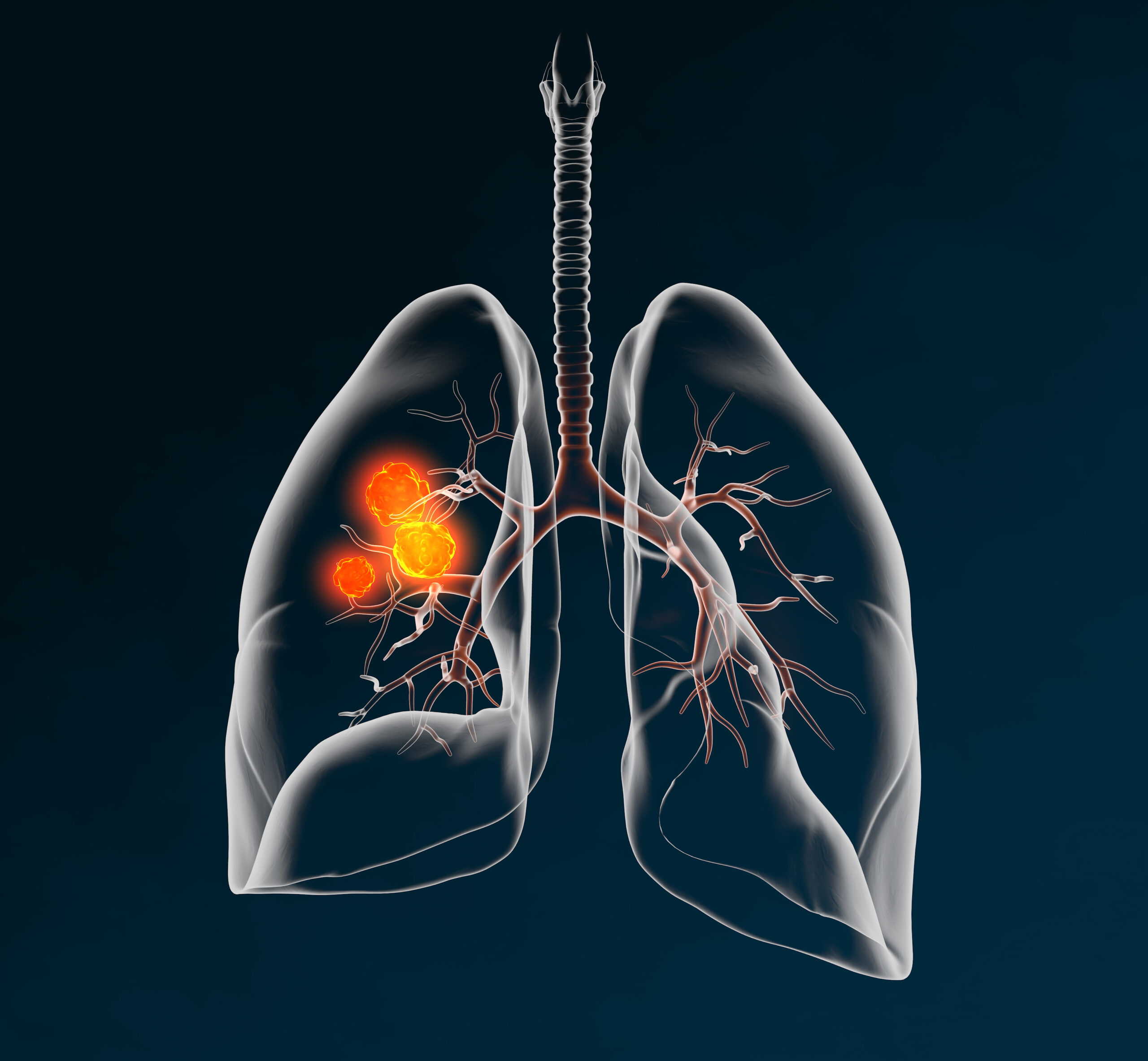 lung-cancer-biopsy-dislodges-tumor-cellsinto-circulating-blood-screencell